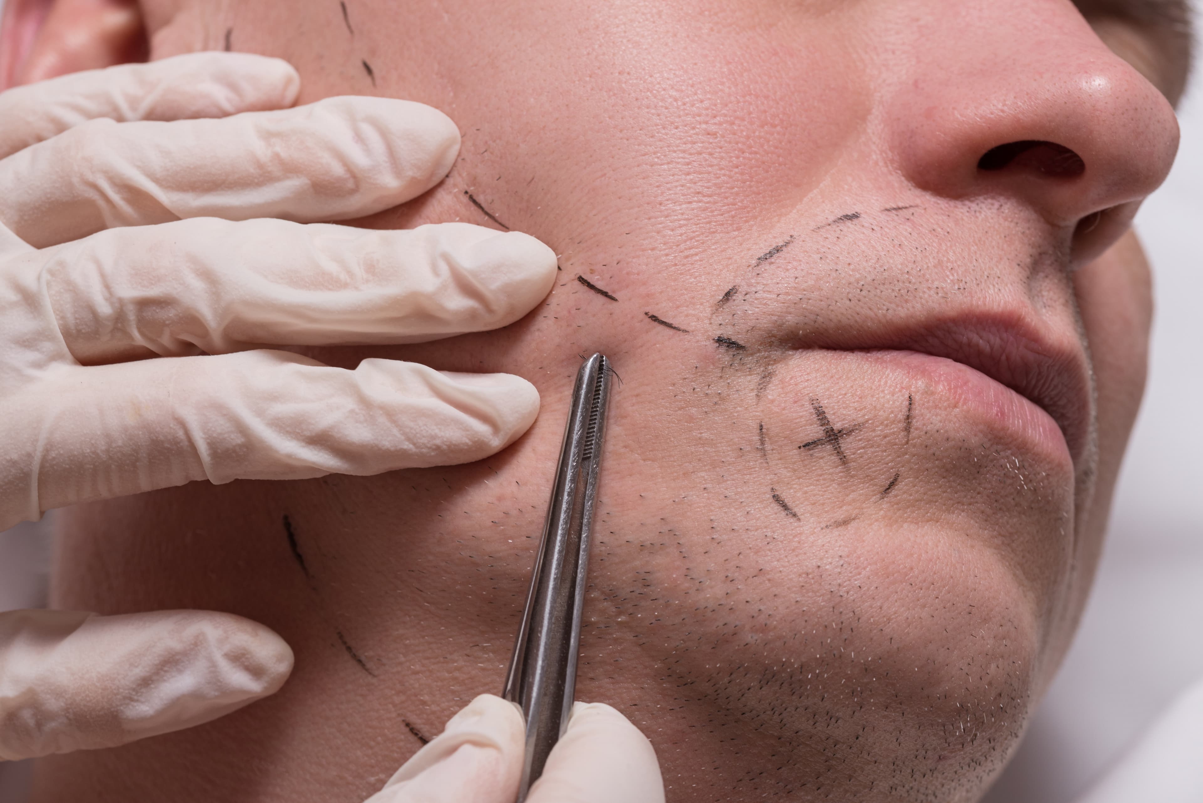 Beard Transplant procedure demonstration