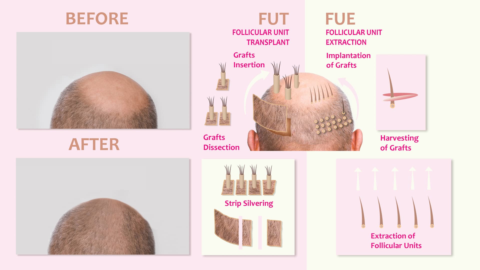FUE VS FUT Hair Transplant Which Is Better | Treat Hair Loss In Men & Women | Permanent Hair Restoration | Hair Transplant Clinic Florida | Hairthetics Hallandale Beach