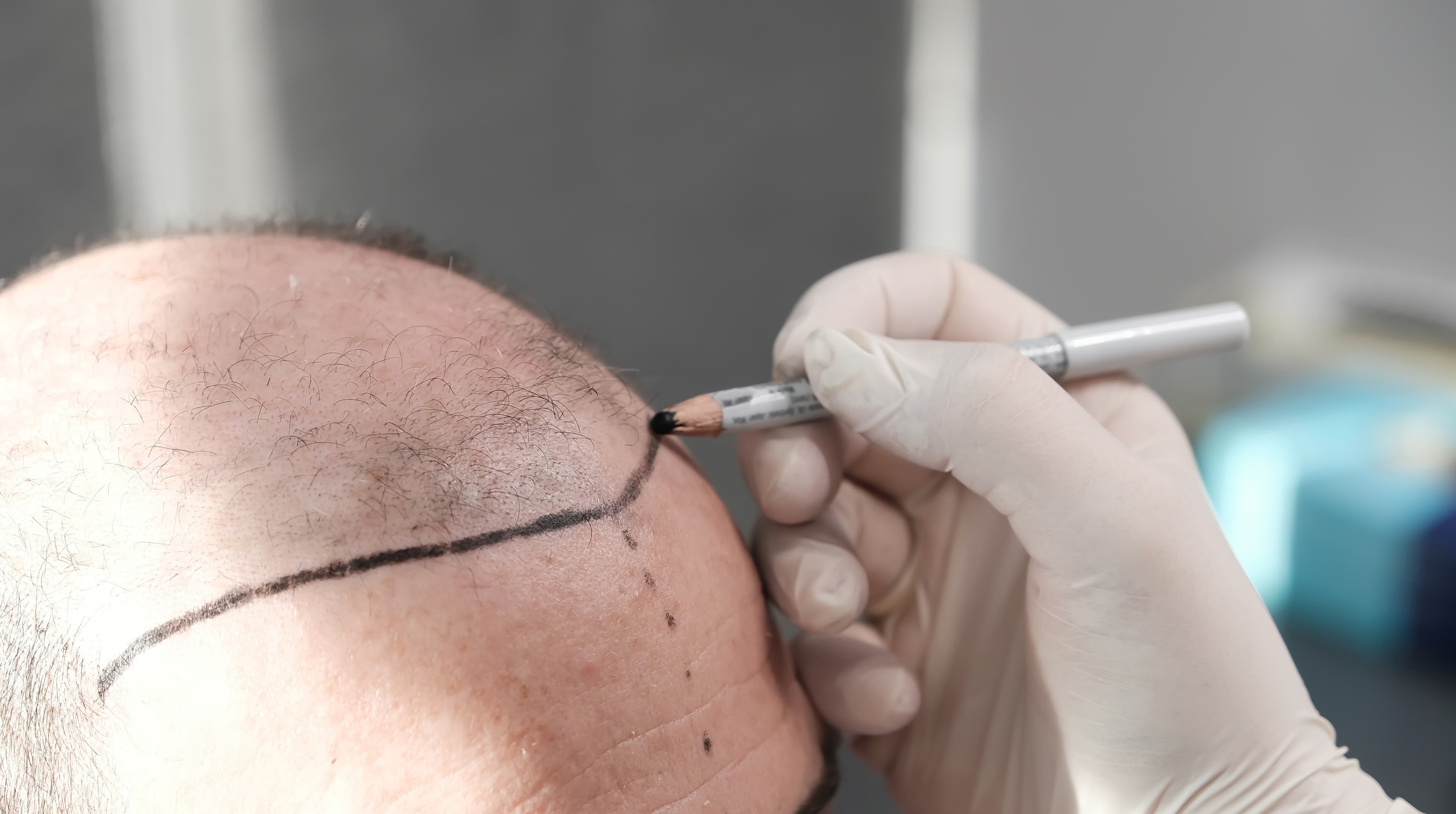 Follicular Unit Extraction VS Follicular Unit Transplantation | FUE Hair Transplant Clinic Florida | Best Hair Transplantation Technique | Hairthetics, Hallandale Beach