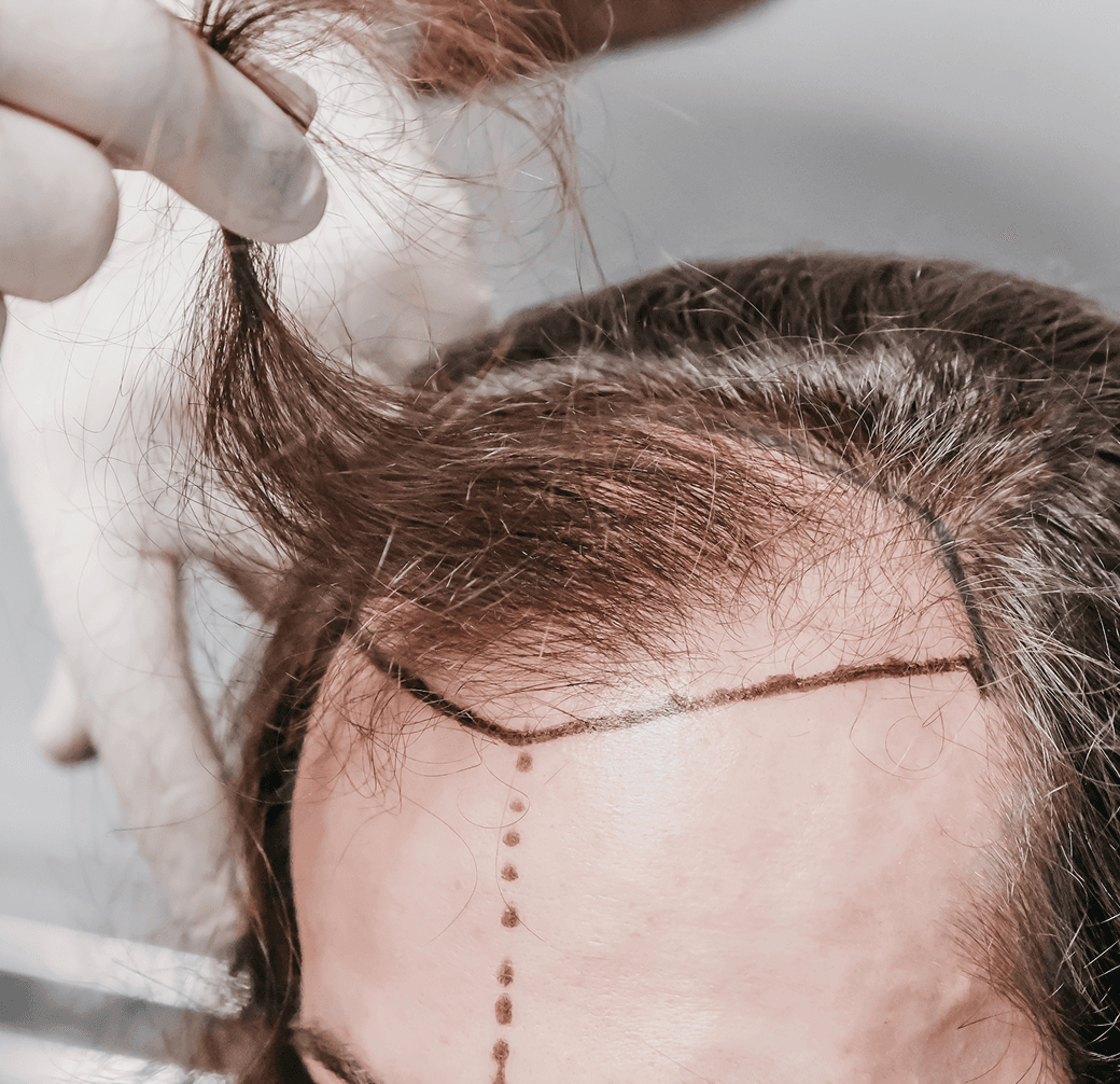 No-Shave FUE procedure demonstration