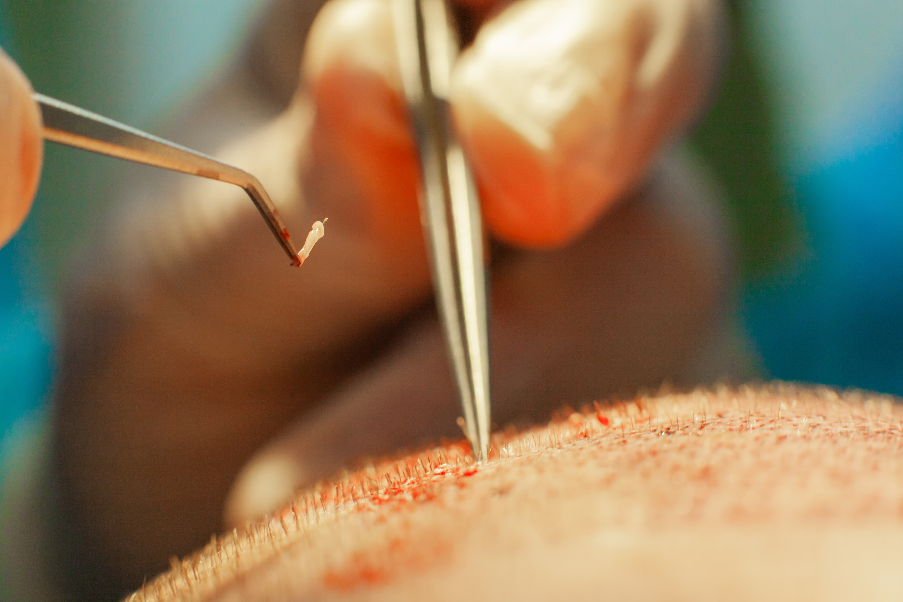 Benefits of Slim FUE