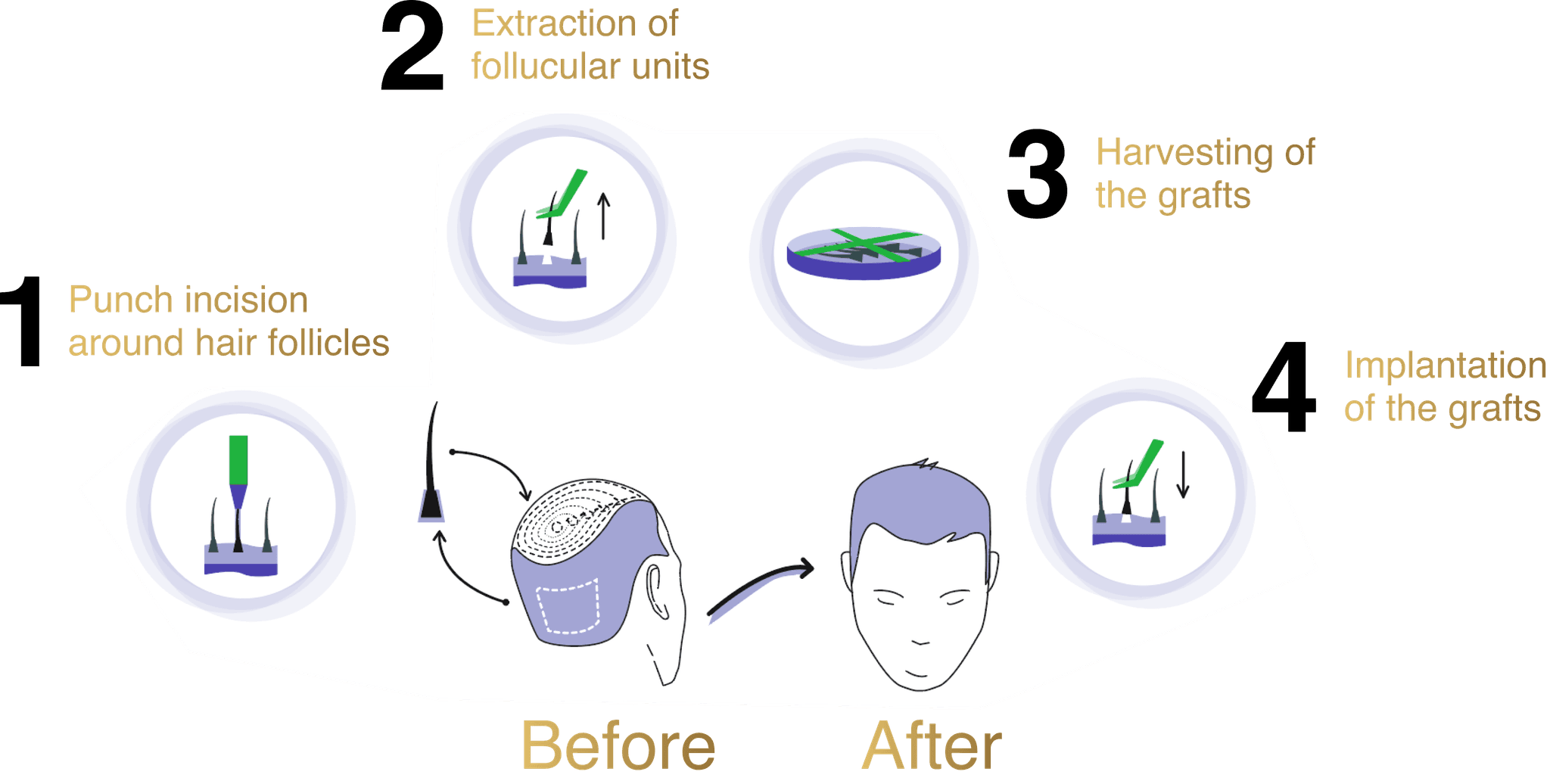 How Slim FUE Works