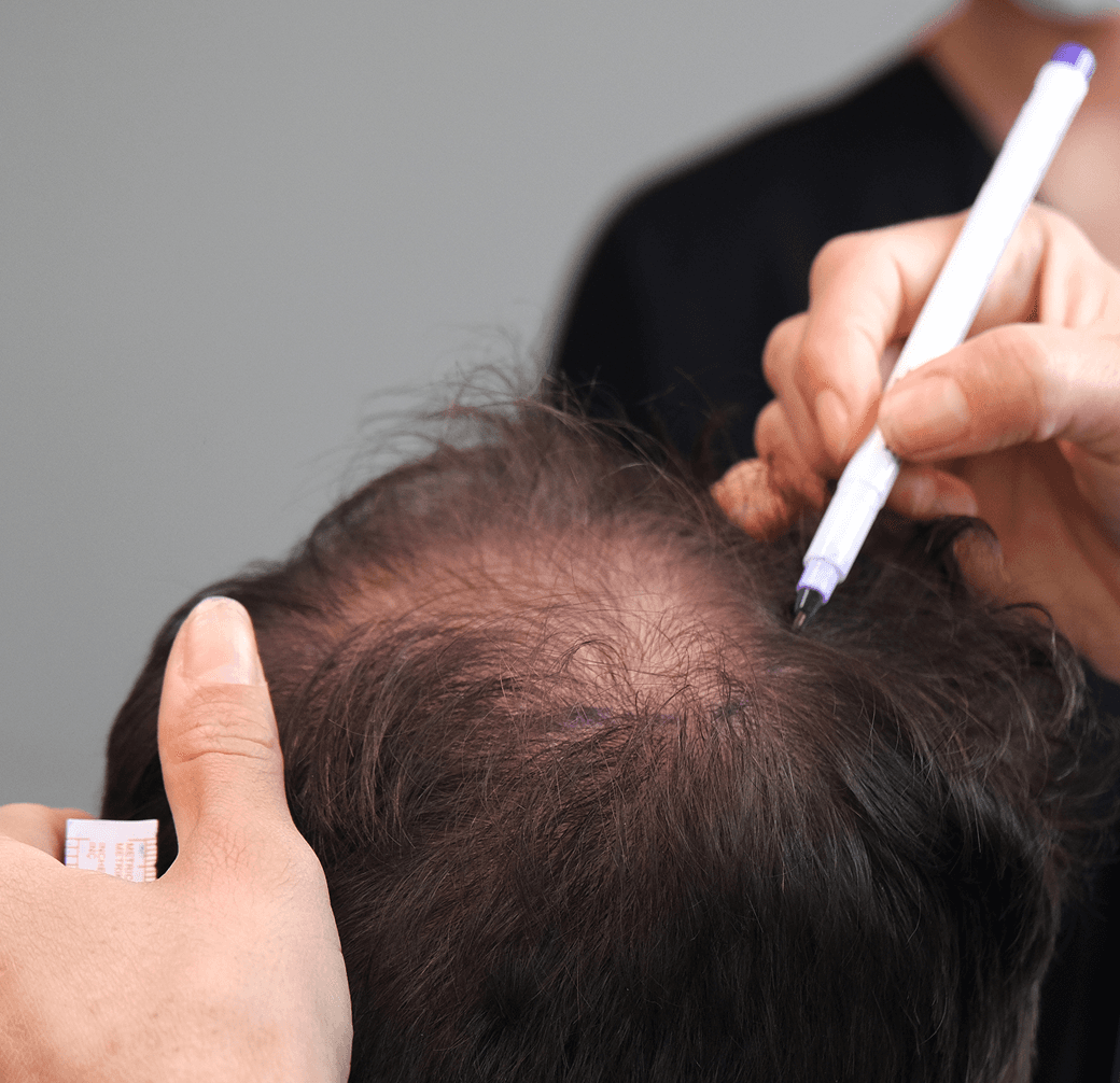 Slim FUE Hair Restoration Treatment