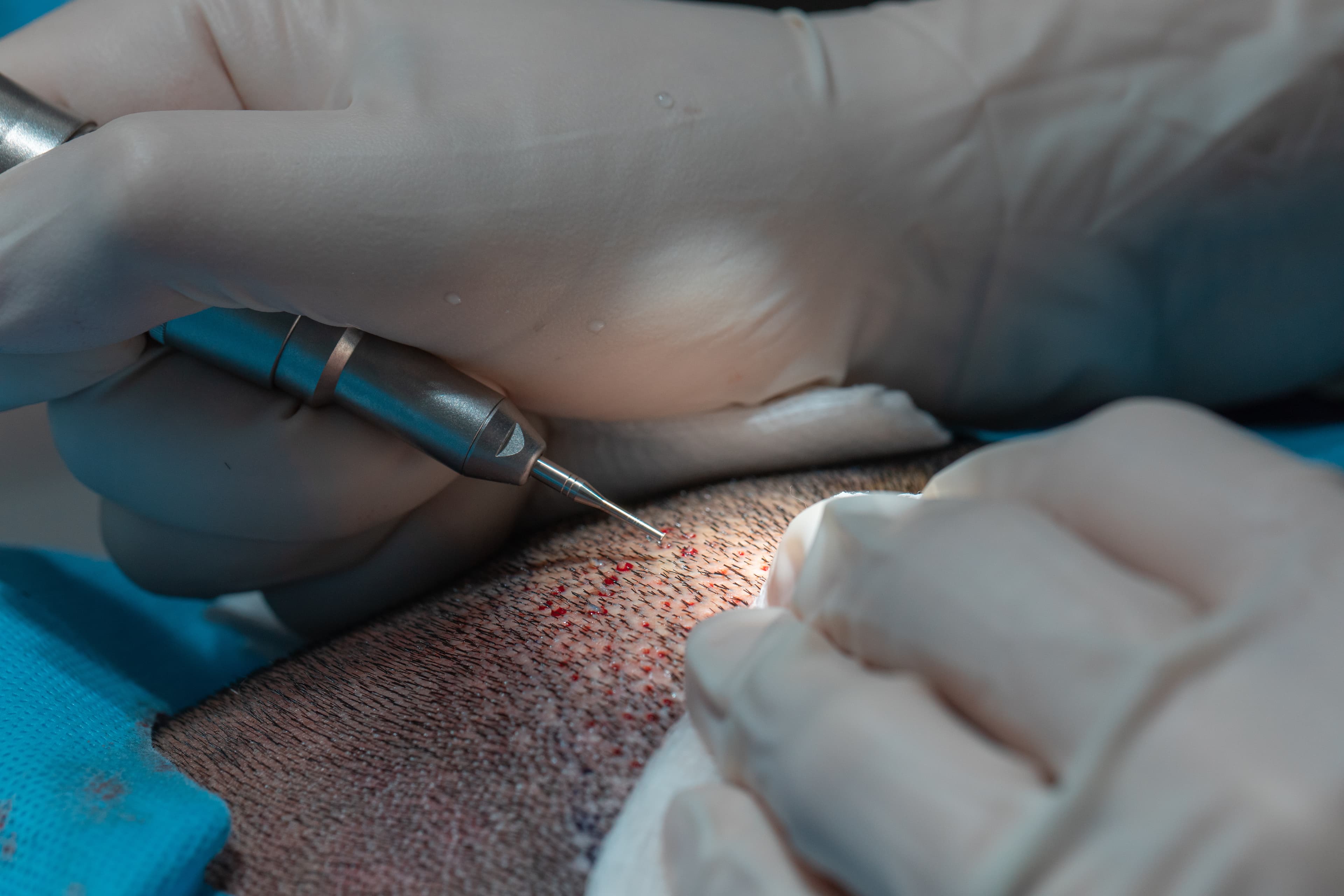 Slim FUE Hair Transplant Procedure