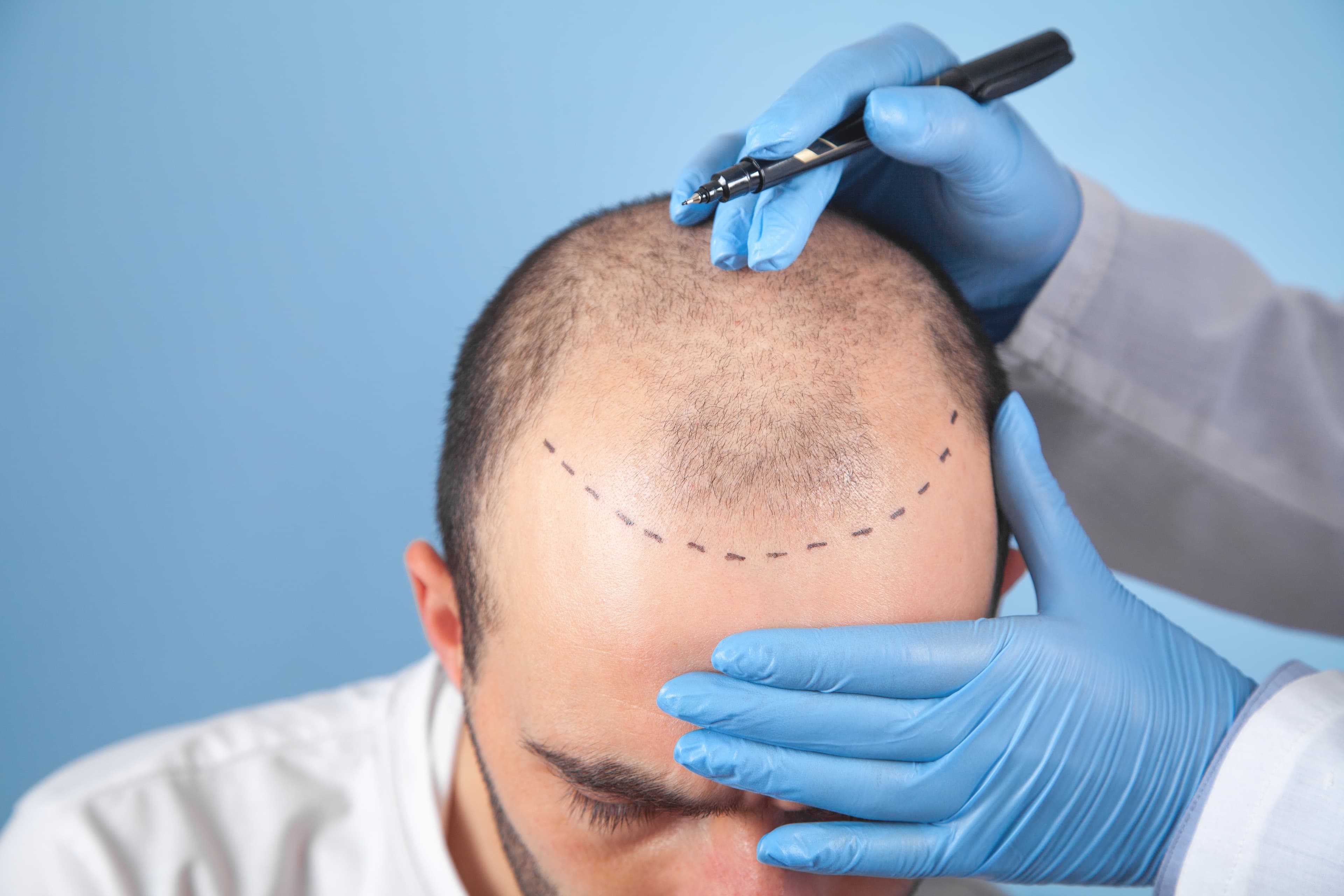 FUE Hair Transplant For Male Pattern Balding & Female Pattern Hair Loss | Advanced Stage Hair Thinning | Best Hair Transplant Technique | Slim FUE | Hair Loss Clinic Hallandale Beach Florida | Hairthetics