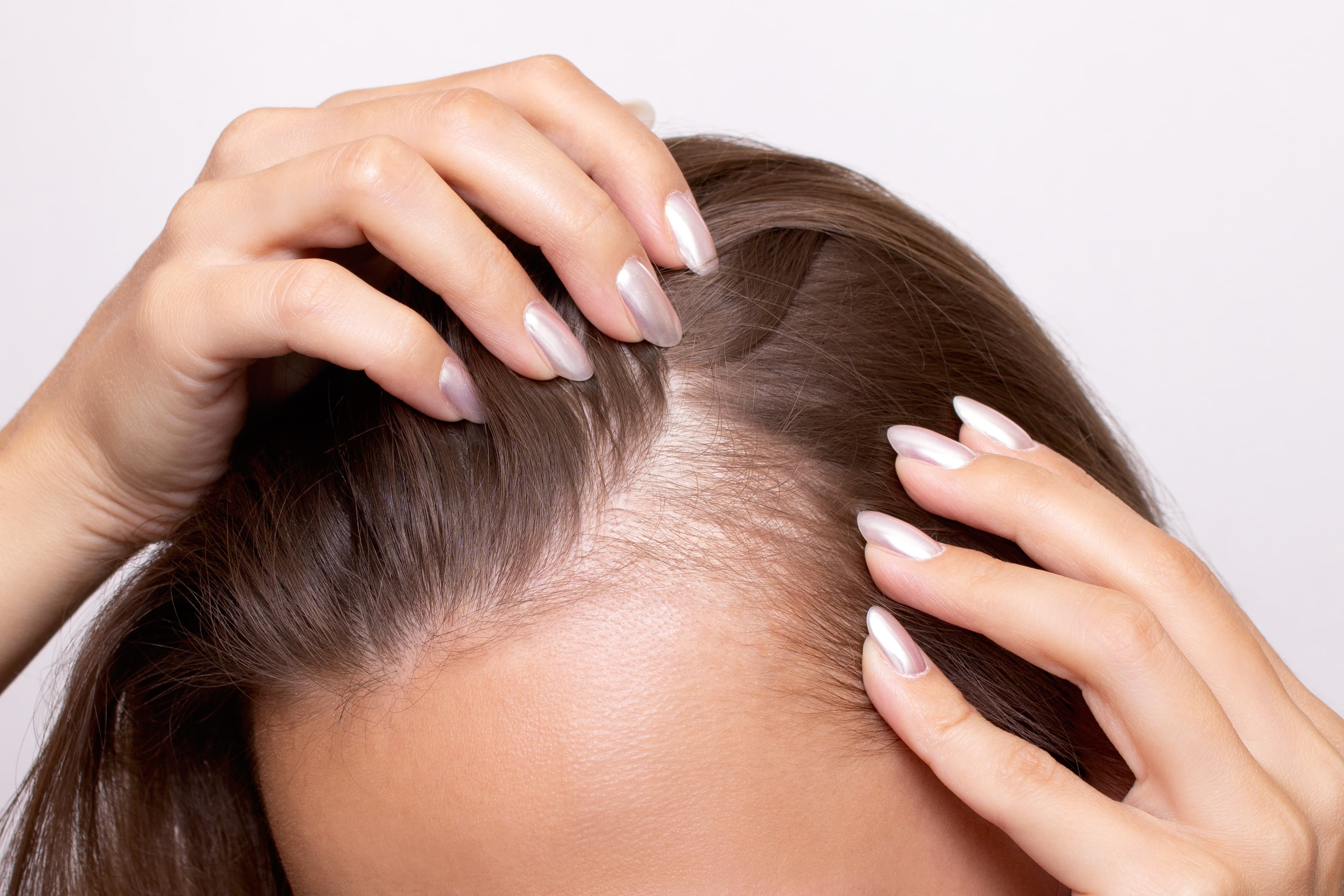 Hair Transplant For Hair Thinning & Female Pattern Hair Loss | No Shave FUE For Long Hair | Hair Transplant Clinic | Hairthetics Hallandale Beach, Florida