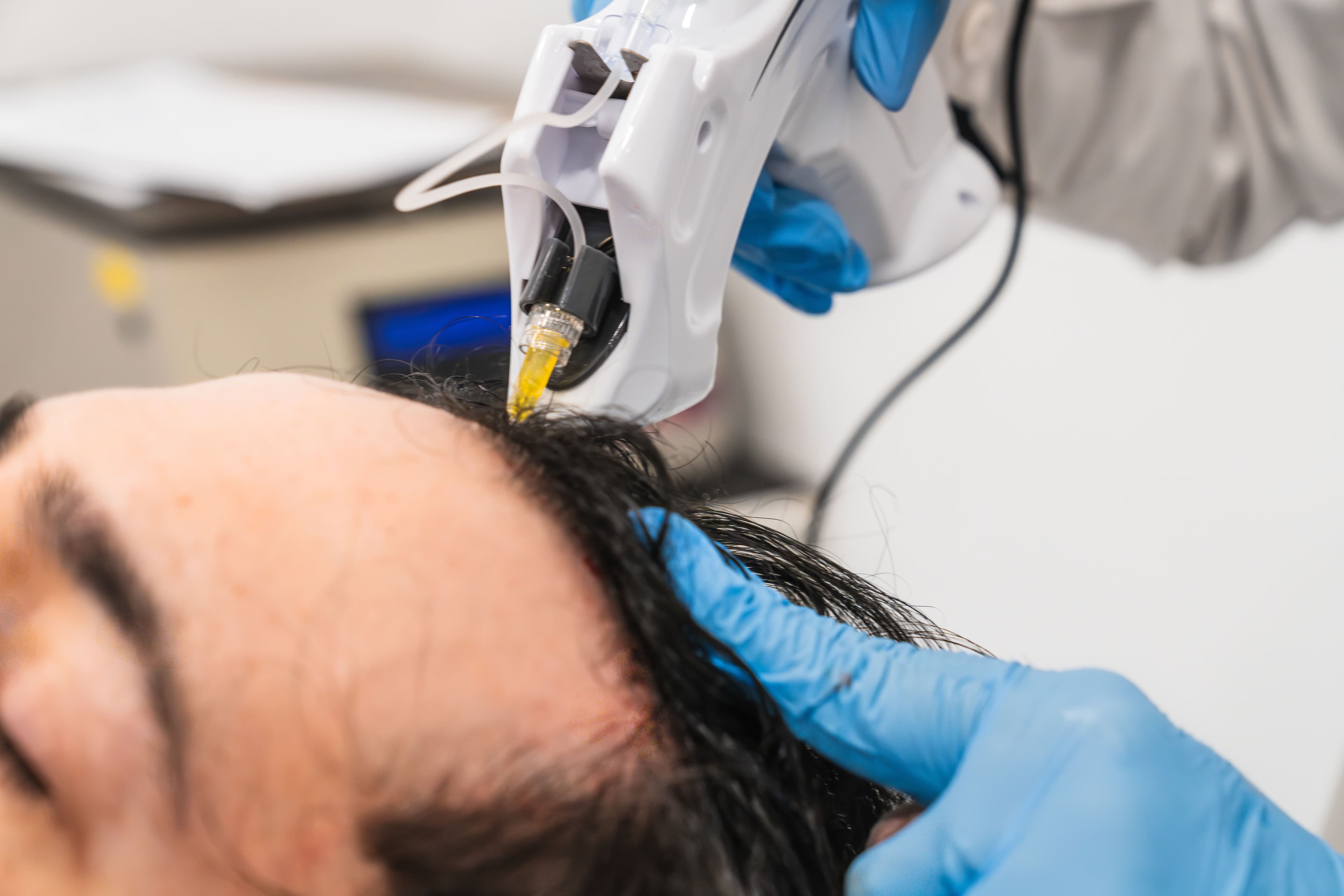 Growth Factor Therapy for Hair Loss Florida | Non-Surgical Hair Restoration | PRP Treatment | Hairthetics Hallandale Beach