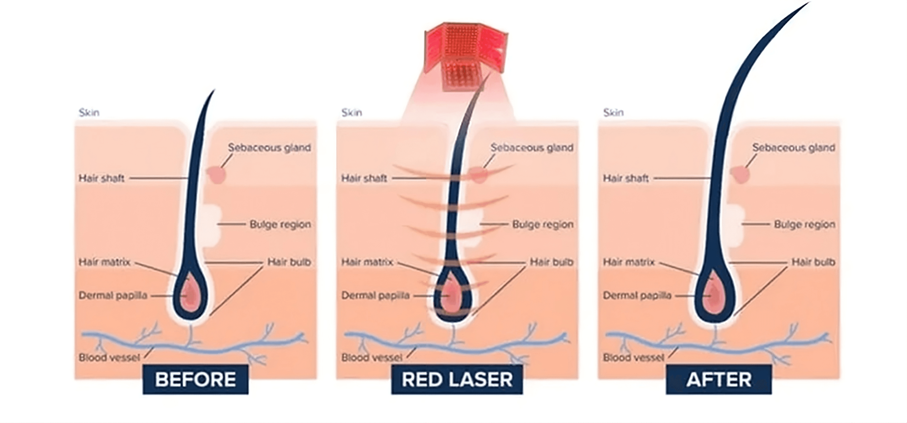 Low-Level Laser Therapy for Hair Loss | Red light therapy | Hairthetics Hallandale Beach